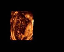 Échographie 3D de 10 semaines de triplets