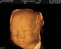 Diaporama de 3D ultrason photos du visage du fœtus