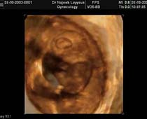 Ediaporama de l'échographie en 3D montrant les fœtus dans la première partie de la grossesse