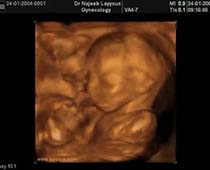 Diaporama de 3D ultrason montrant de la seconde partie de grossesse