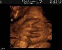 معرض صور لاطراف الجنين داخل الرحم بجهاز الموجات فوق صوتية ثلاثي الأبعاد 2