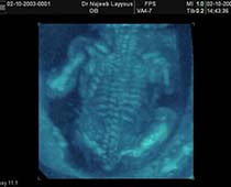 Diaporama de 3D ultrason photos du squelette du fœtus
