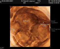 Diaporama de 3D ultrason photos gynécologues