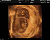 3D Multiple Pregnancy Ultrasound Scan Photos Slide Show