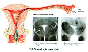 H.S.G اجراء صورة ملونه للرحم