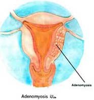Adenomyosis حالة