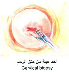 وضعية السيدة عند أخذ عينة من عنق الرحم