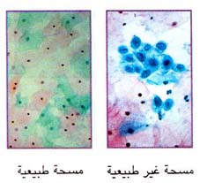 مسحة غير طبيعية / مسحة طبيعية