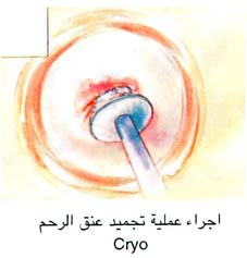 اجراء عملية تجميد عنق الرحم