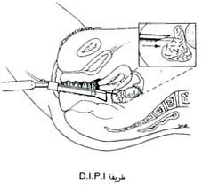 D.I.P.I طريقة