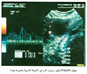  يظهر سريان الدم في الأوعية الدمويةبصورة جيدةDoppler جهاز 