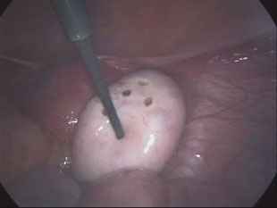 Drilling Of PolyCystic Ovary