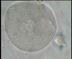 Magnified 3 Pronuclei in abnormally fertilized Oocyte