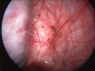 Endometriotic Spots