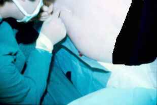 اجراء التخدير فوق الجافية يقوم به الدكتور نجيب ليوس في عام 1982