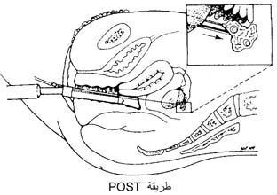 P.O.S.T طريقة