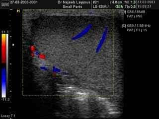 ورم سيرتولي بالخصية مع دوبلر