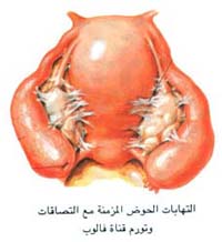 التهاب ملحقات الرحم المزمن