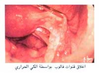 اغلاق قنوات فالوب بواسطة الكي الحراري