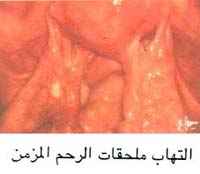 التهابات الحوض المزمنة مع التصاقات وتورم قناة فالوب