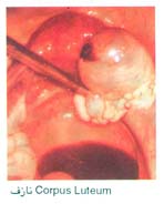 نازف Corpus Luteum