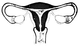 Transvaginal Intrafallopian Insemination