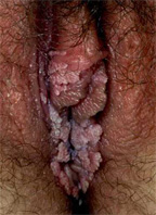vulval warts