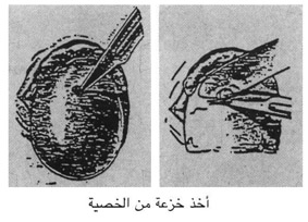 أخذ خزعة من الخصية