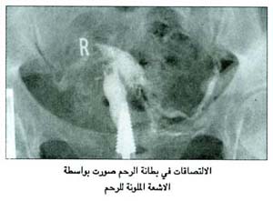 التصاقات بطانة الرحم بواسطة الاشعة الملونة للرحم