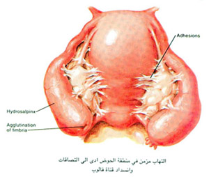 التهاب مزمن في منطقة الحوض أدى الى التصاقات وانسداد قناة فالوب