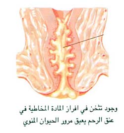 تثخن الماده المخاطية في عنق الرحم