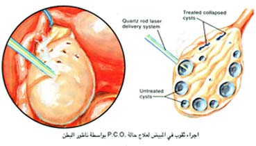 تثقيب المبايض بالتنظير البطني