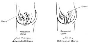 رحم منقلب / رحم وضعه طبيعي