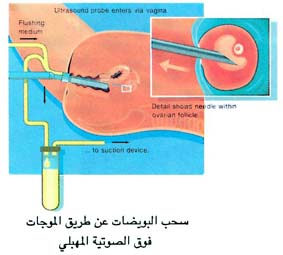 سحب البويضات عن طريق الموجات فوق الصوتية المهبلي