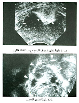 صورة ملونة تظهر تجويف الرحم مع بداية قناة فالوب / المادة الملونة تصور المبيض