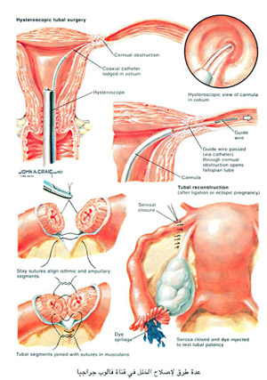 عدة طرق لاصلاح الخلل في قناة فالوب جراحيا