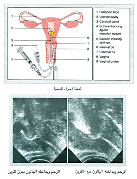 كيفية اجراء العملية