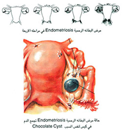 مرض البطانه الرحمية في مراحله الاربعة 