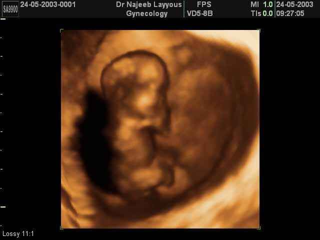 10 Weeks Fetus