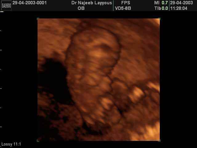 13 Weeks Fetus