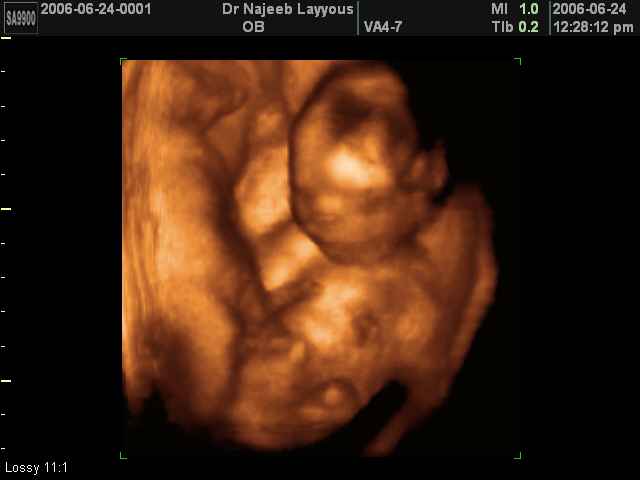 17 Weeks Fetus