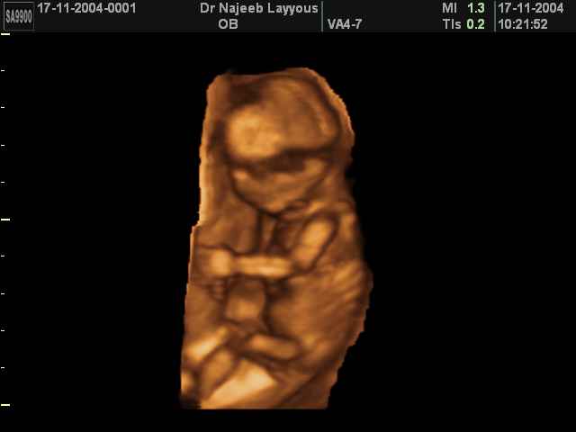 18 Weeks Fetus
