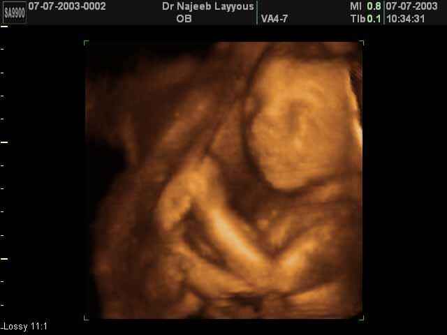 24 Weeks Fetus