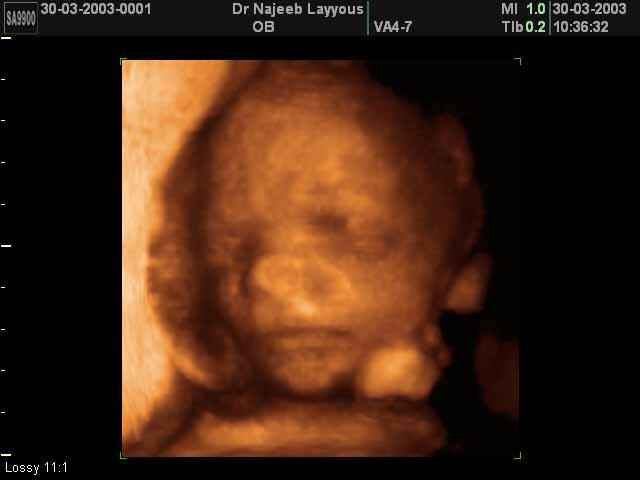 26 Weeks Fetus