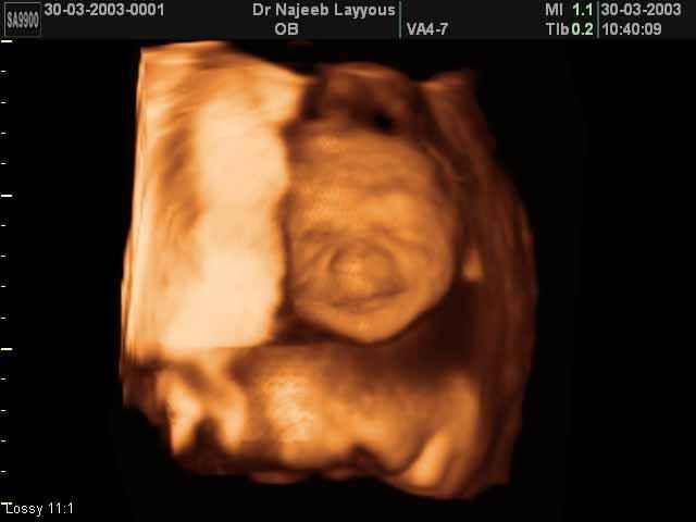 26 Weeks Fetus