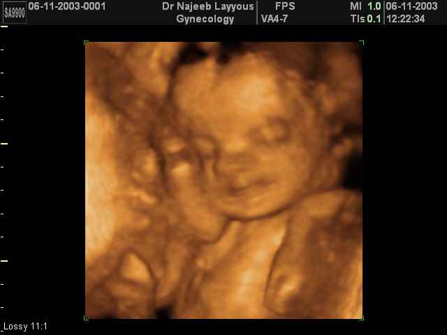 28 Weeks Fetus