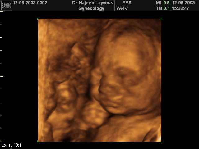 33 Weeks Fetus