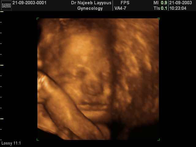 34 Weeks Fetus