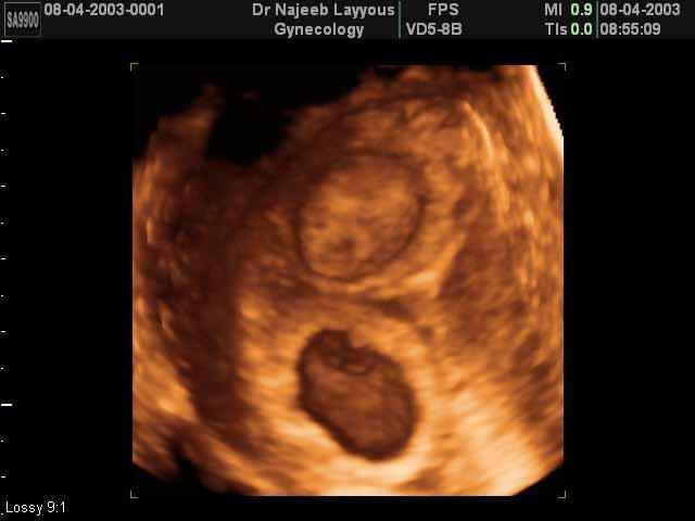 7 Weeks Twins Pregnancy