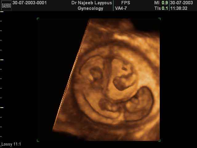 8 Weeks Quadruplets Pregnancy